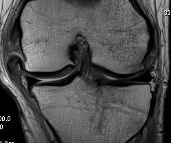 Acute MCL avulsion with rollback